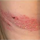 Illustration for article titled obat penyakit herpes pada kulit